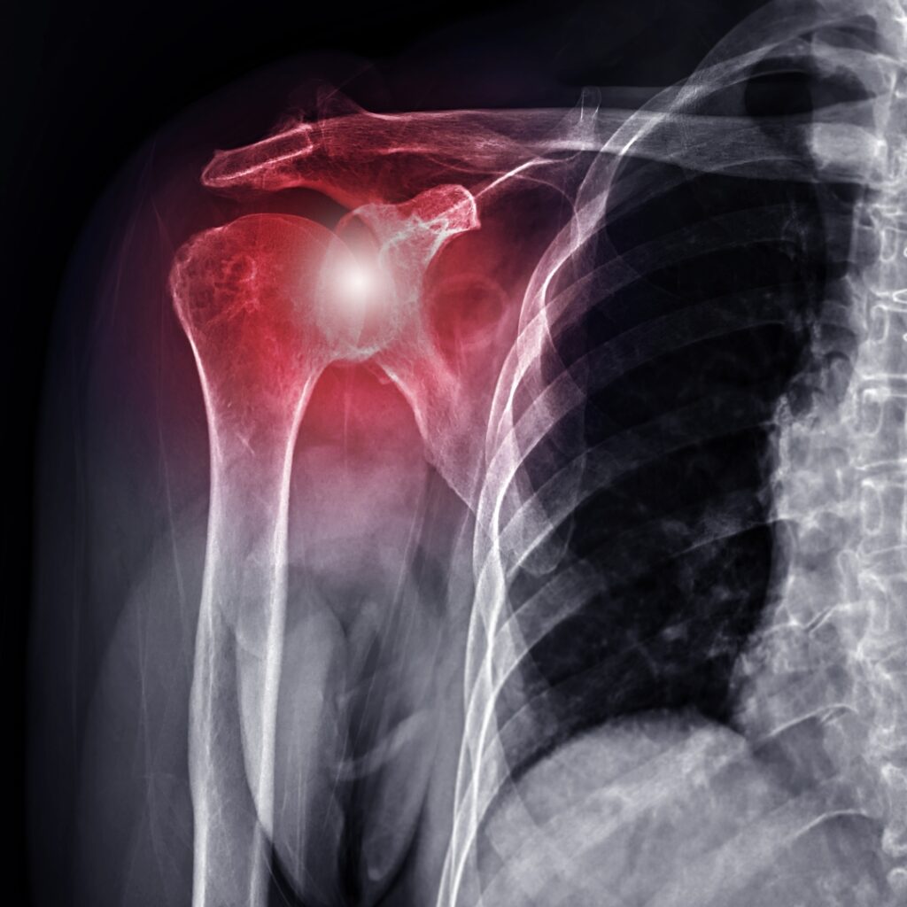Shoulder Surgery 15 Richard B. Jones, MD Shoulder & Clavicle Fracture Surgery