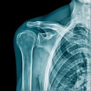 shoulder replacement asheville nc