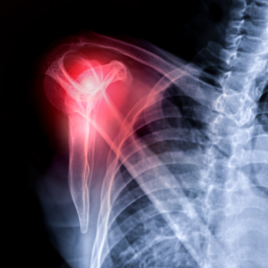 Shoulder & Clavicle Fracture Surgery
